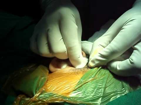 Preauricular sinus excision-1.AVI