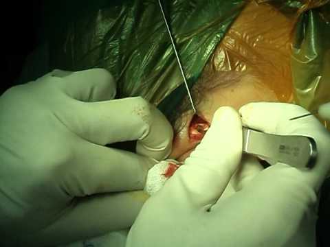 Preauricular sinus excision-part2.AVI