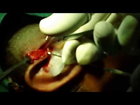 Preauricular Sinus in Children-Surgical Excision