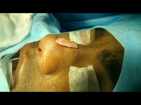 Preoperative Analysis Before Rhinoplasty