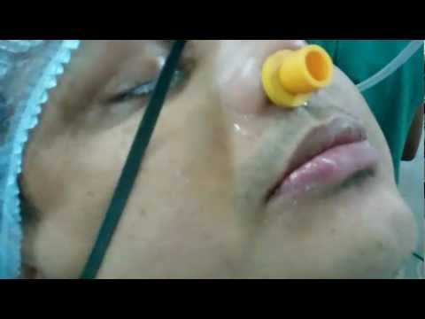 Recovery After Snoring and OSA Surgery