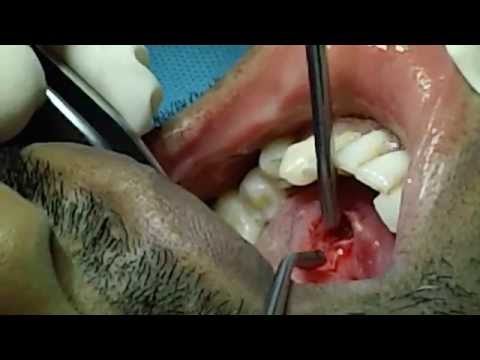 Removal of Salivary Gland Duct Calculi Using Laser