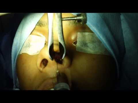 Rhinoplasty and Septoplasty Combined:Pre Op Planning