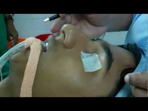 Rhinoplasty@19:Rhinoplasty in Teen Age?