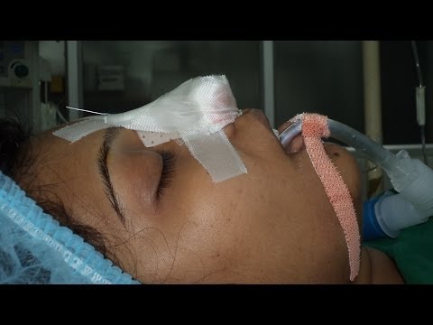 Rhinoplasty-Cosmetic Surgery in India -4