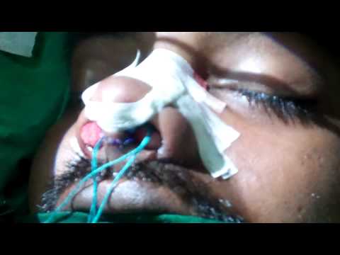Rhinoplasty Final Dressing:Post Op