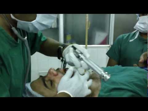 Rhinoplasty : General Anesthesia (Intubation)