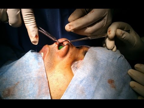 Rhinoplasty-How to make a big nose small ?