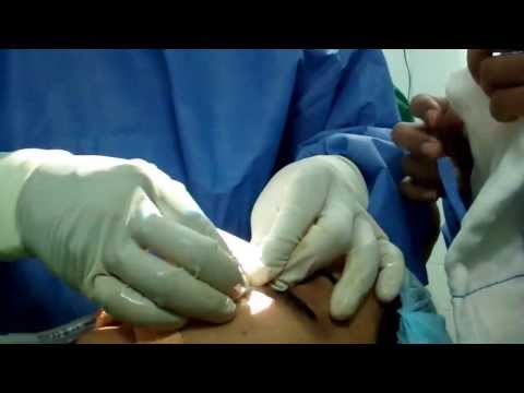 Rhinoplasty in an Indian Girl:Final Dressing
