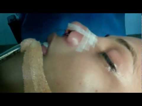 Rhinoplasty in India:Applying Steristrips