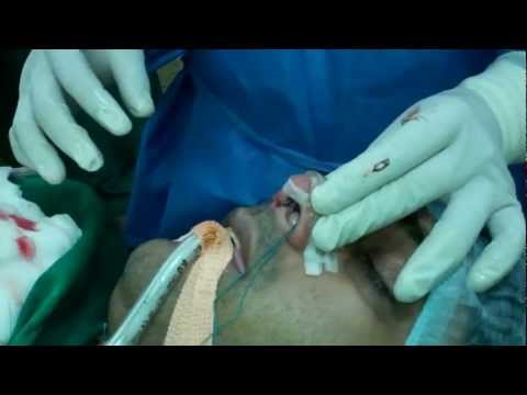 Rhinoplasty in India:Cosmetic Nose Job
