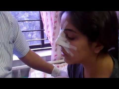 Rhinoplasty in India:Day 2:Pack Removal