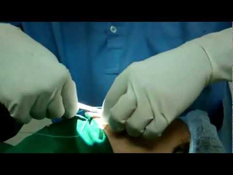 Rhinoplasty In India:Final Packing and Dressing