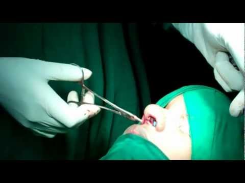 Rhinoplasty in india :Final Suturing technique