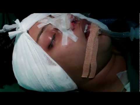 Rhinoplasty in India:Harvesting Conchal Cartilage