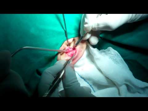 Rhinoplasty in India: Harvesting Ear Cartilage