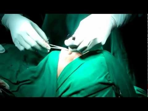Rhinoplasty in india : How final suturing done?