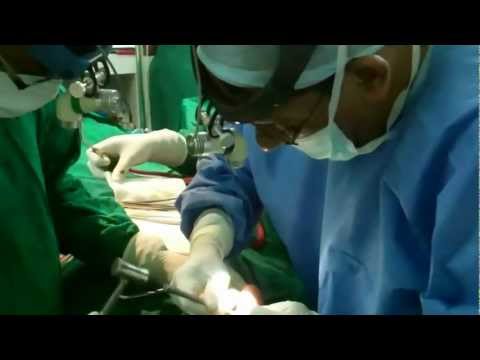 Rhinoplasty in India:Hump Reduction-Osteotomies