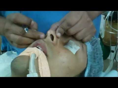 Rhinoplasty In India:Pre Operative Evaluation