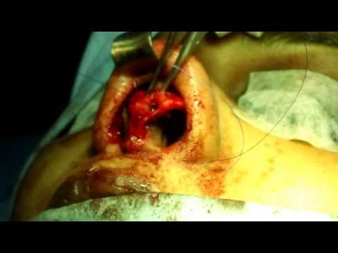 Rhinoplasty in India-Small Nose made bigger