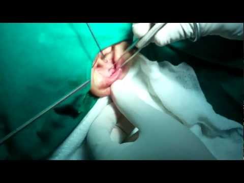 Rhinoplasty in India:Taking Ear Cartilage