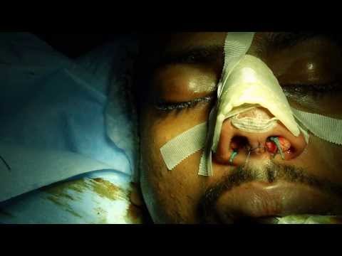 Rhinoplasty in India-Thermoplast Splint