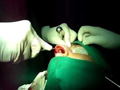 Rhinoplasty in India:Trivandrum