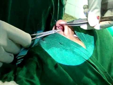 Rhinoplasty in Jubilee Hospital Trivandrum, India-1.AVI