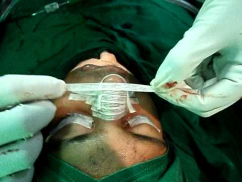 Rhinoplasty in Jubilee Hospital, Trivandrum, India-2.AVI
