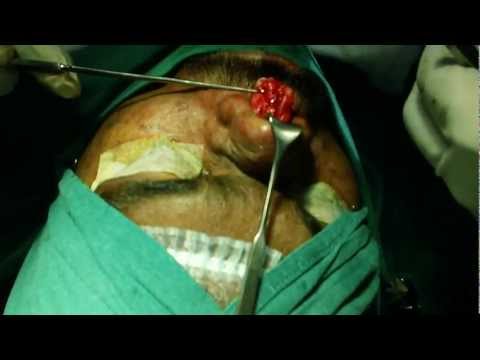 Rhinoplasty in Oily and Thick Skin