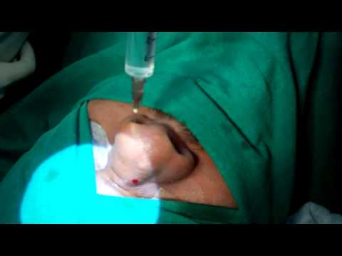 Rhinoplasty in Thick Skin Indian Nose