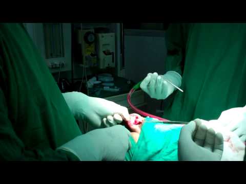 Rhinoplasty in Thick Skin is a challenge