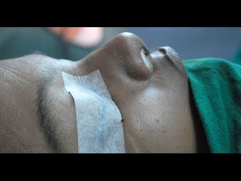 Rhinoplasty in Women-Preop Planning