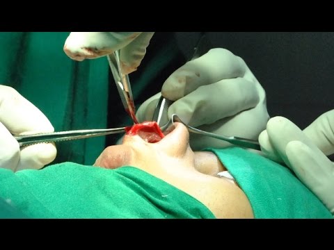 Rhinoplasty is a surgery of millimeters