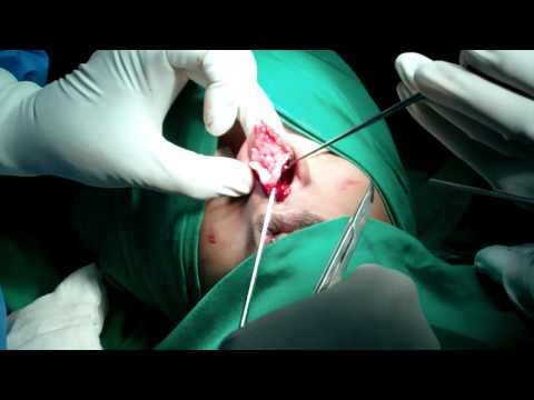 Rhinoplasty: Nose Job: Open or Closed:Which is Better?