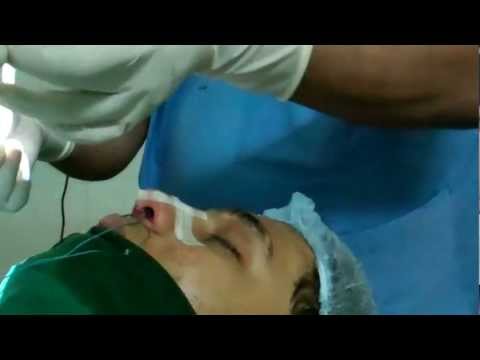 Rhinoplasty:Packing and Dressing