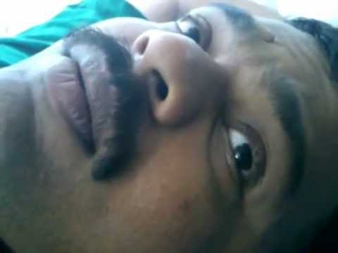 Rhinoplasty Planning in bulbous thick skin Nose