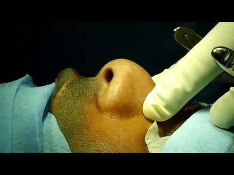 Rhinoplasty Planning- Per Op Assesment