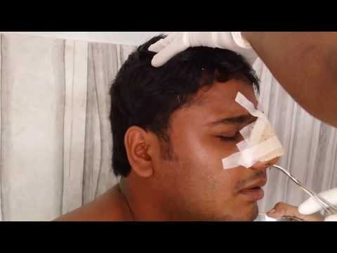 Rhinoplasty:Post Op Pack Removal