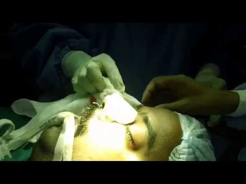 Rhinoplasty Procedure Completed