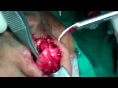 Rhinoplasty Procedure in Action