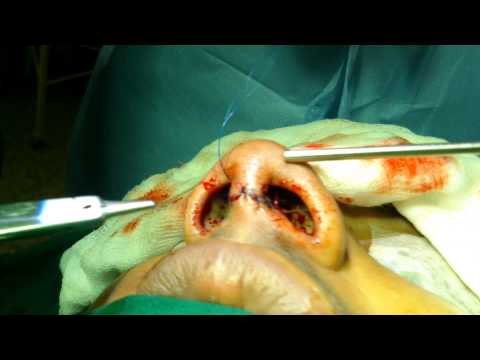 Rhinoplasty:Skin Closure
