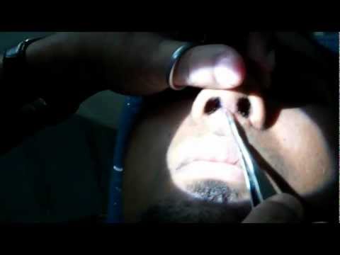 Rhinoplasty:Suture Removal