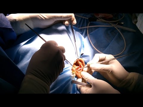 Rhinoplasty using Ear Cartilage Graft (India)