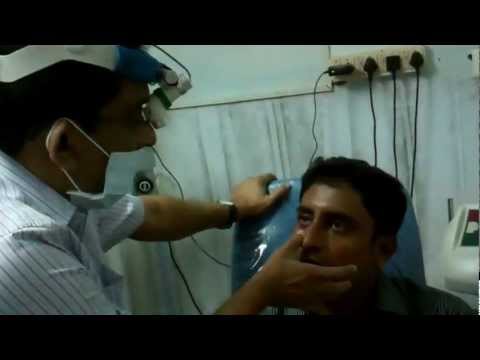 Rhinoplasty with Septoplasty In India