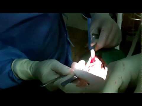 Rhinoplasty with Septoplasty:Post Traumatic Case