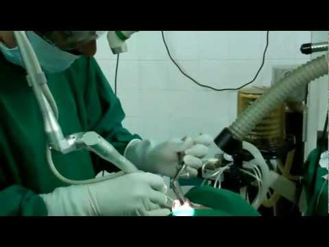 Rhinosporidiosis:Laser treatment