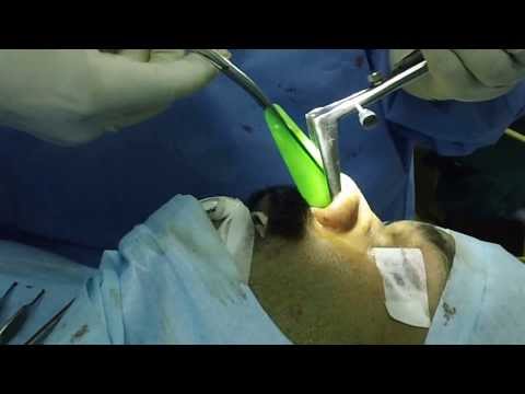 Rinoplasty-Silastic Splints