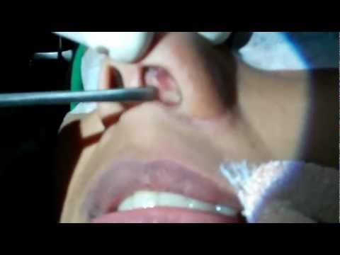 Risk of doing Septoplasty in Children