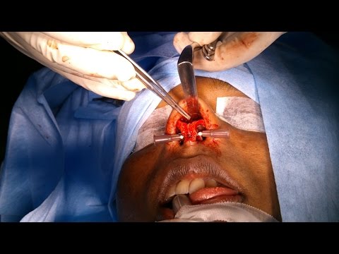 Saddle Nose Deformity Reconstruction